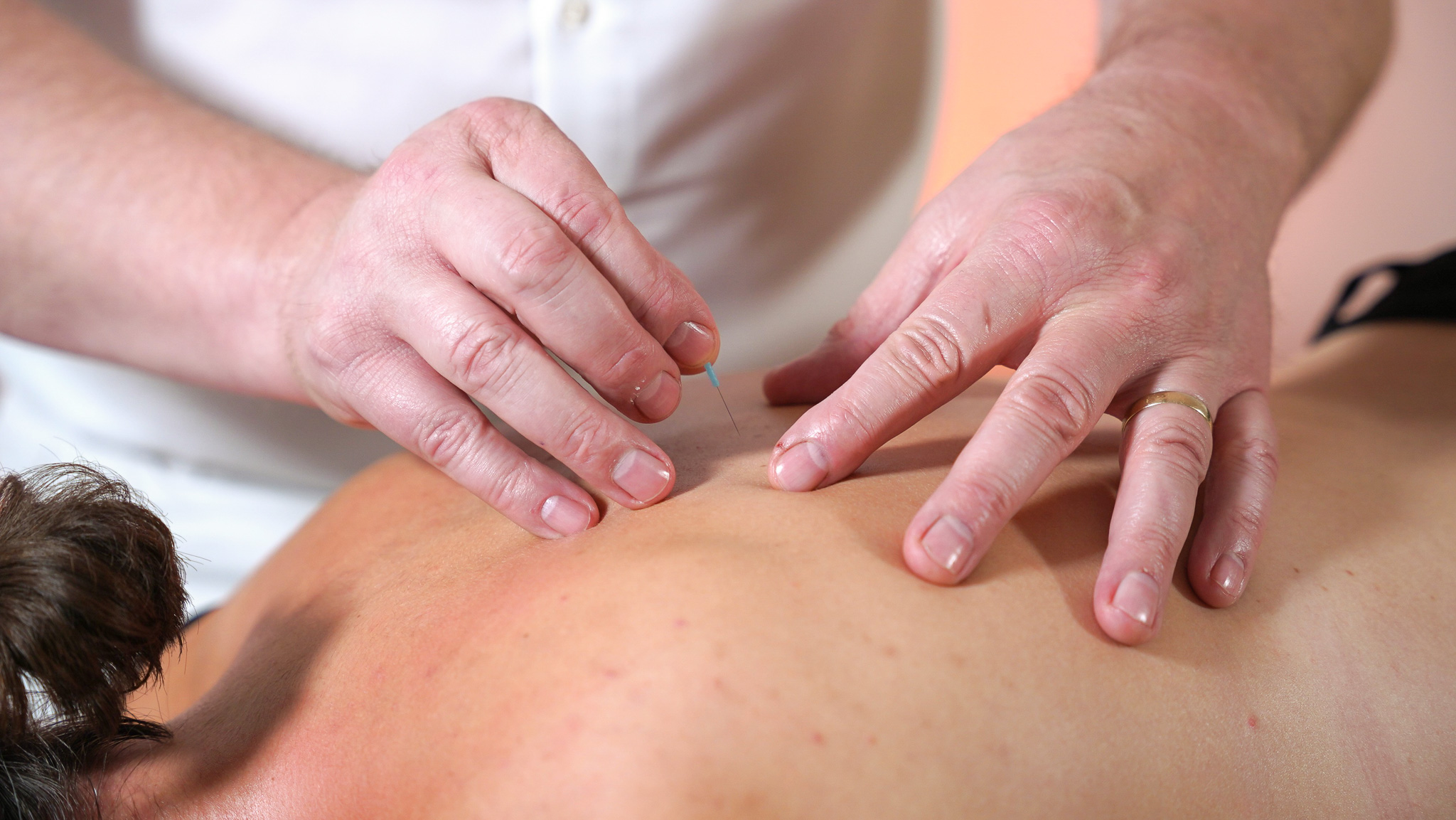 Akupunktur Pforzheim